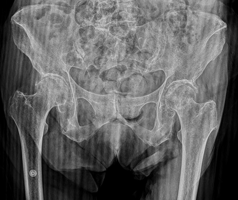 2/5/2024. DIAGNOSIS - Left femoral subcapital fracture: cortical step and hyperdense trabecular line seen in both AP and axial #XRAY. Just confirmed it with #CT to evaluate the grade of impaction and dorsal / ventral angulation. #MSK #traumatwitter