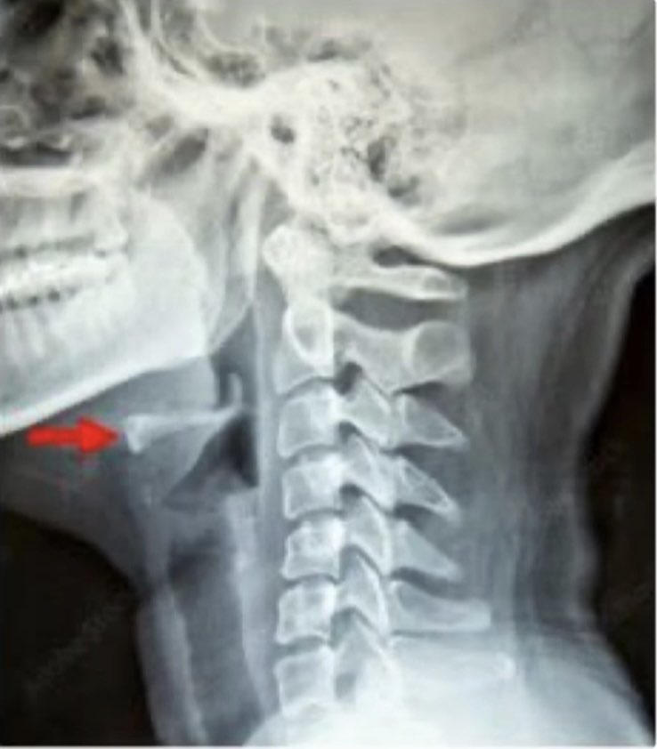 👨🏻‍⚕️ Identify the arrow marked structure 🤔

A) Hyoid bone
B) Thyroid cartilage
C) Trachea
D) Cricoid cartilage