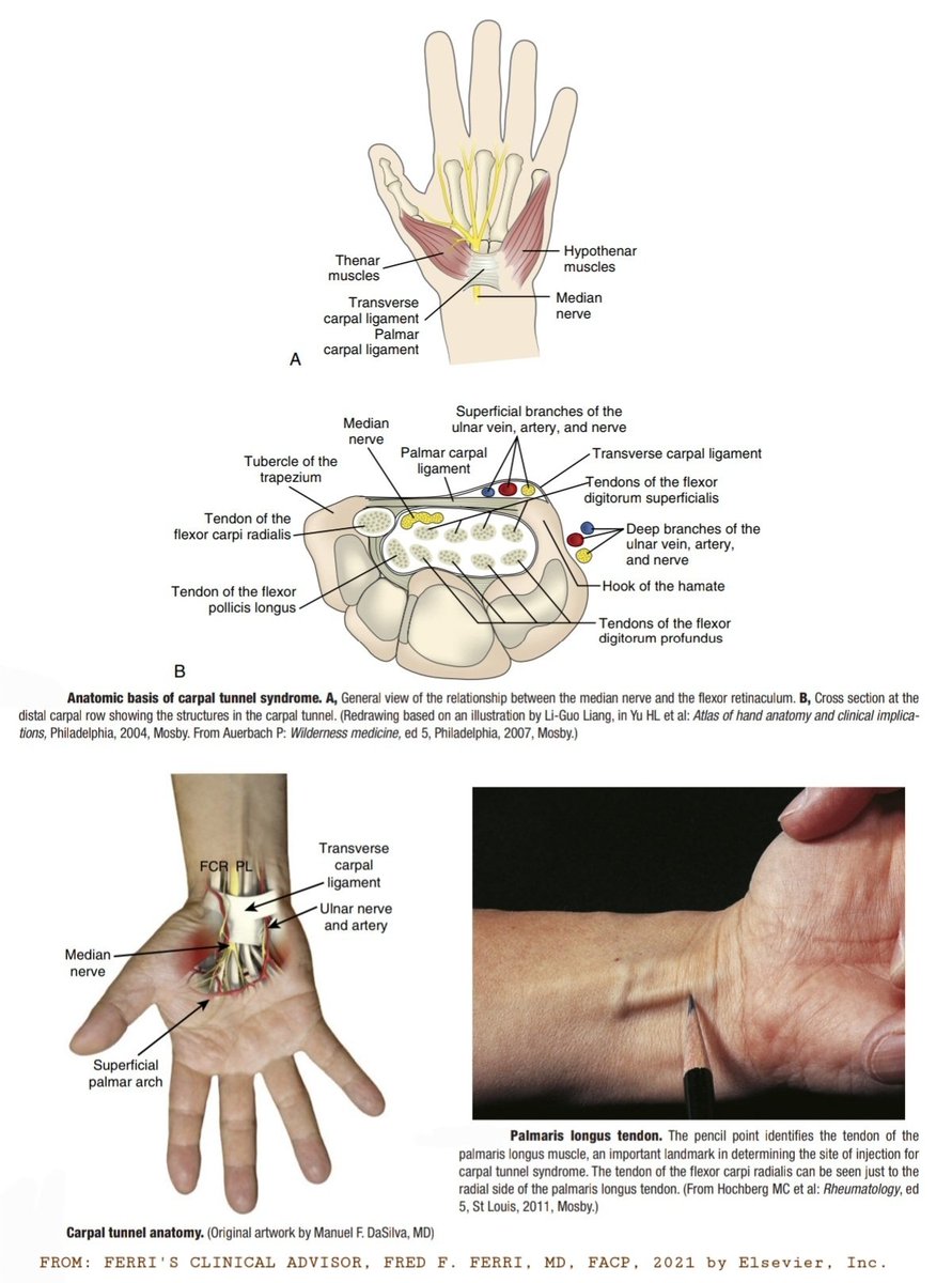 Carpal tunnel anatomy as well as Carpal Tunnel Syndrome(CTS) beautifully illustrated👍CTS is a compression neuropathy of median nerve as it passes under the transverse carpal ligament at the wrist.

Just notice the location of Palmaris longus tendon which is an important landmark