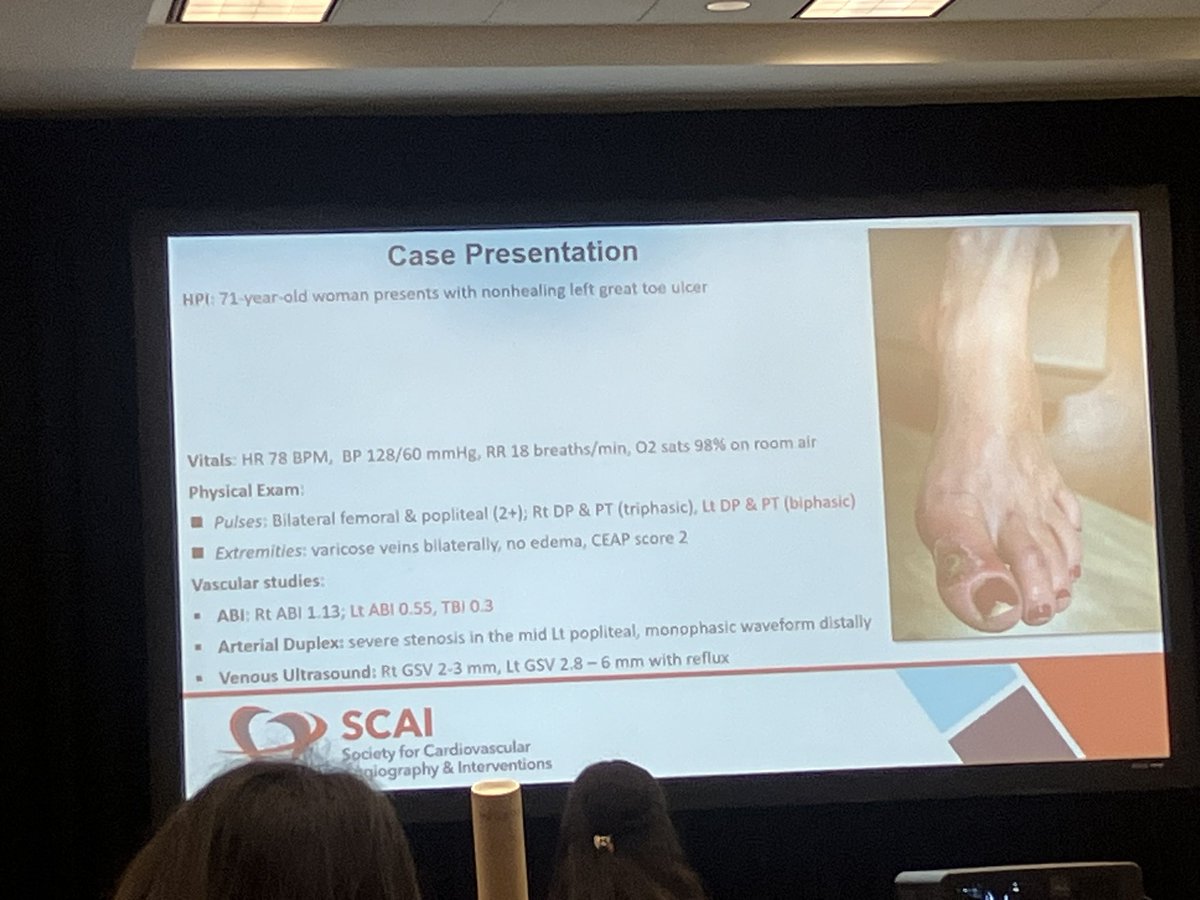 SriPittaMD's tweet photo. Managing #CLI #PAD #peripheralvascular @SCAI #SCAI2024 multidisciplinary team along with using right tools #drugelutingballoon #spiderfilter protecting distal runoff @Pooh_Velagapudi @nadia_sutton @mirvatalasnag @georgedangas @esbrilakis @JunLiMD https://t.co/tg66WDaBHj