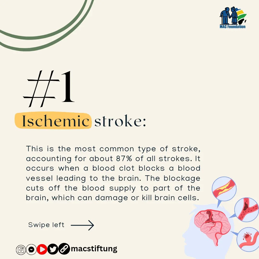 macstiftung's tweet photo. Stroke 101: What It Is and the Types You Should Be Aware Of
#stroke #strokeawareness #strokesurvivor #health #brainhero #knowthesigns #ischemicstroke #hemorrhagicstroke #transient #tia #ministroke #weakness #strokethriver #macstiftung #amici23 #FreePalestine #UCLA #Eurovision https://t.co/2dk4RDfzIy