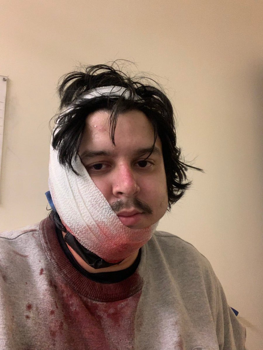 A UCLA student shot in the head with rubber bullets.