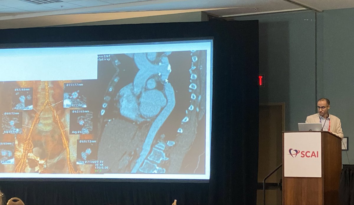 Nice case presentation by @saleh_alshalash at @SCAI