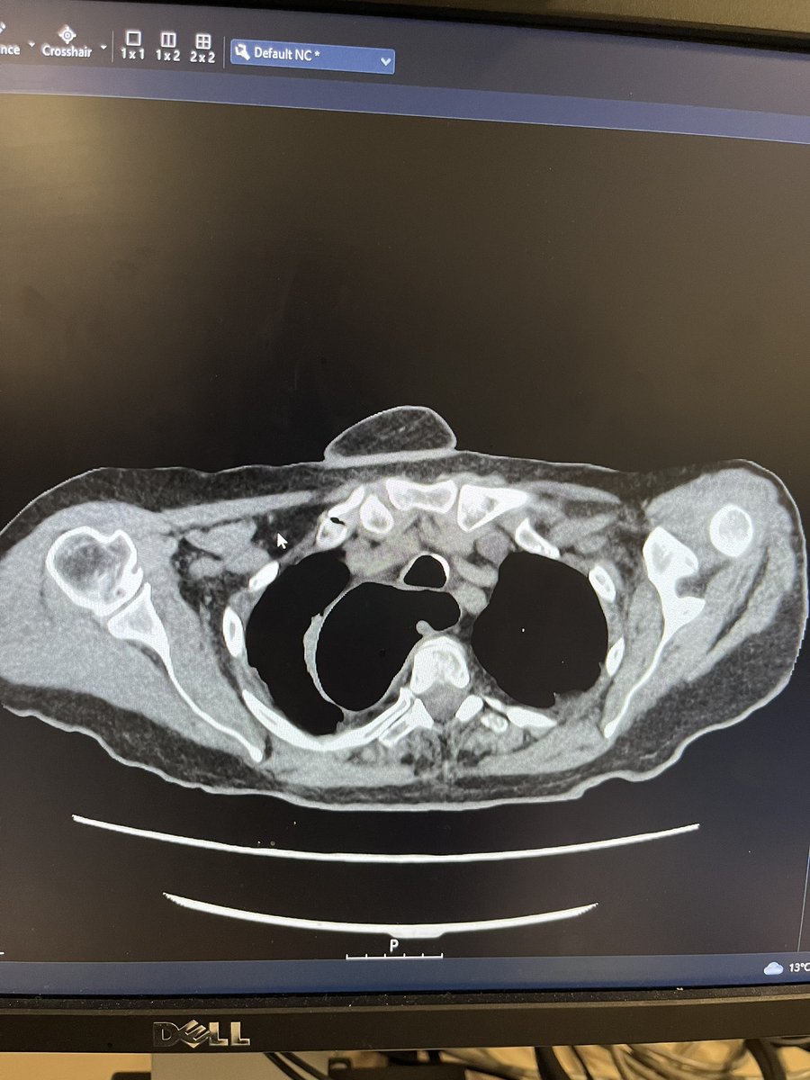 Large oesophageal dilatation ( achalasia) with thickening presenting as right upper zone cavitatory lesion/ atelactatic band. The apparent pleural line on left side is just an artefact as u can see vascular markings beyond that.