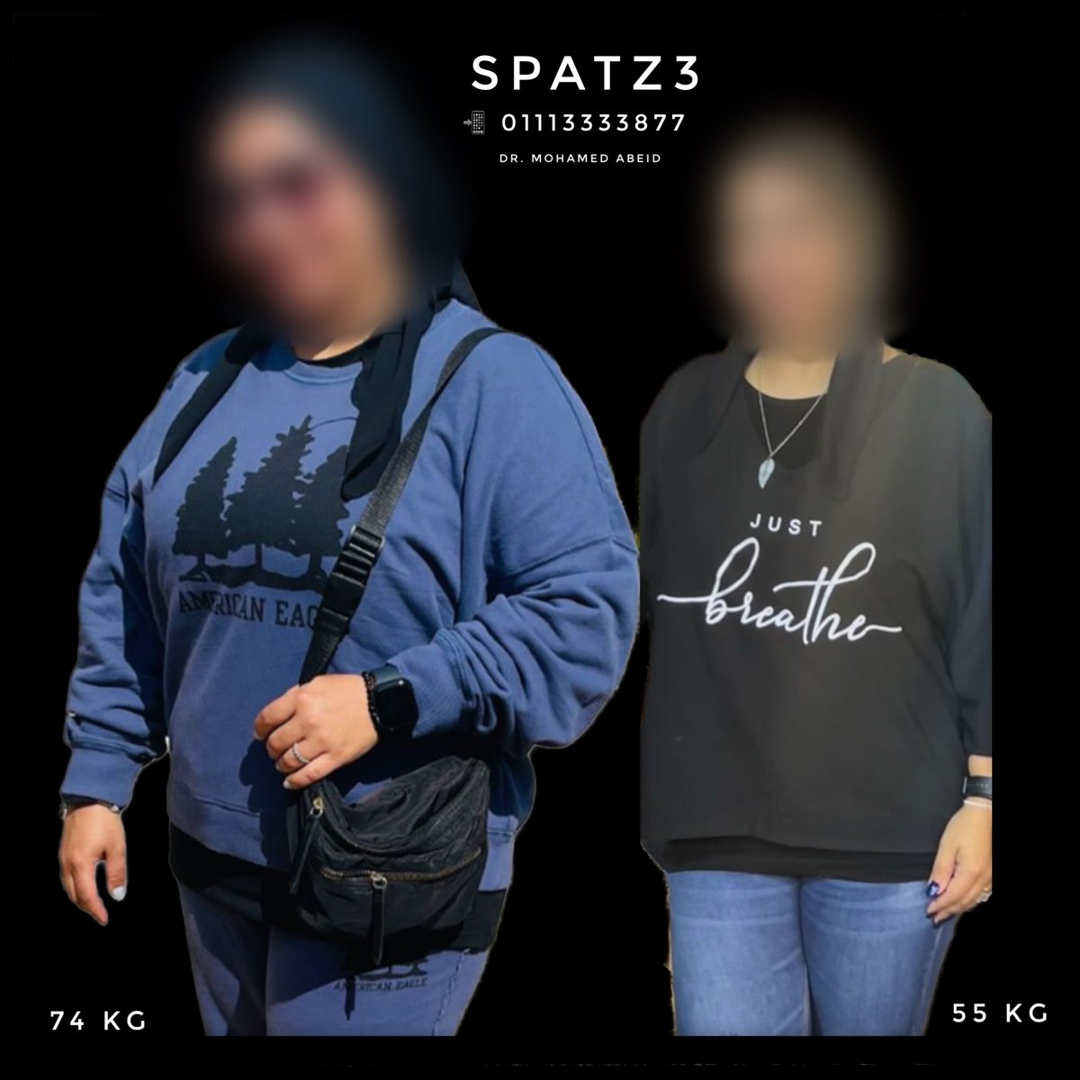 MohamedAbeid's tweet image. Only with #SPATZ3; the best #weightloss solution!!
100 % EWL
24 % TWL