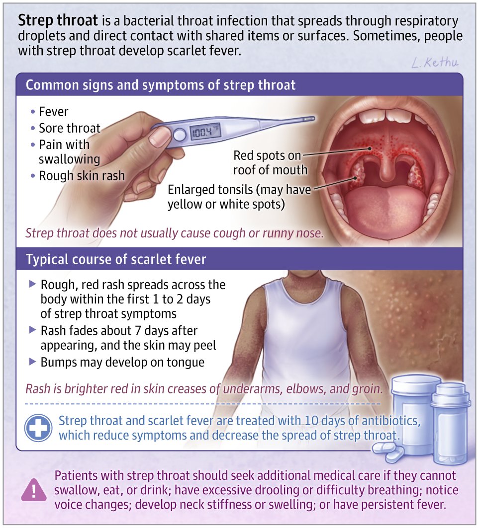 Strep throat is an infection of the throat caused by Streptococcus pyogenes bacteria (Group A Streptococcus). This JAMA Patient Page describes strep throat, its signs and symptoms, diagnosis, treatment, and potential complications. ja.ma/49Xc8c8
