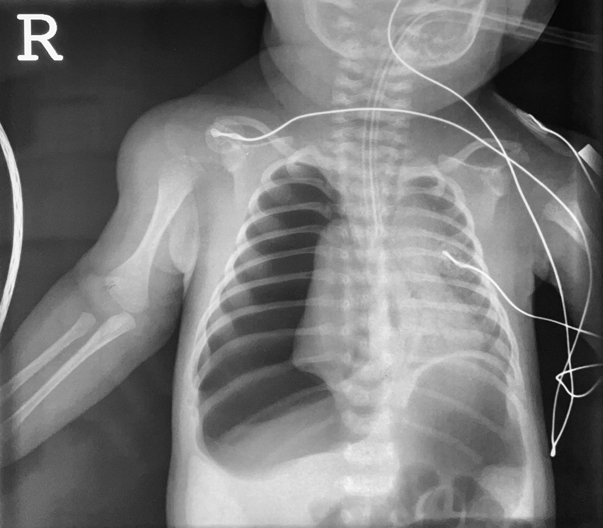 Images in #Anesthesiology - Too Much of a Good Thing: Iatrogenic Pediatric Pneumothorax from Engagement of the Oxygen Flush Valve 📷 ow.ly/Xmyz50Rv7rt