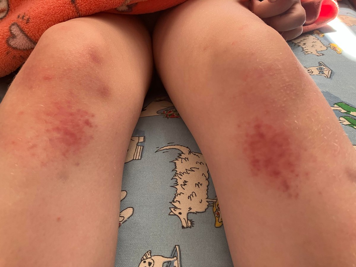 #PansPandasHour This month we've had more non-blanching rashes and a particularly painful new tic which is pretty much constant. She's 7. #PANS #PANDAS children don't want sympathy. They want fury + outrage. @1goodtern @CounsellingSam @75ThunderRoad @Hopesaxons @carolvorders