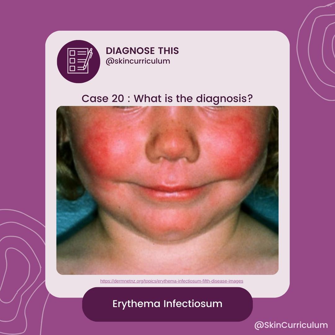 #POPQUIZ 
⚡What the most likely diagnosis?
✅Swipe for the answer!

#MedEd #derm #dermatology