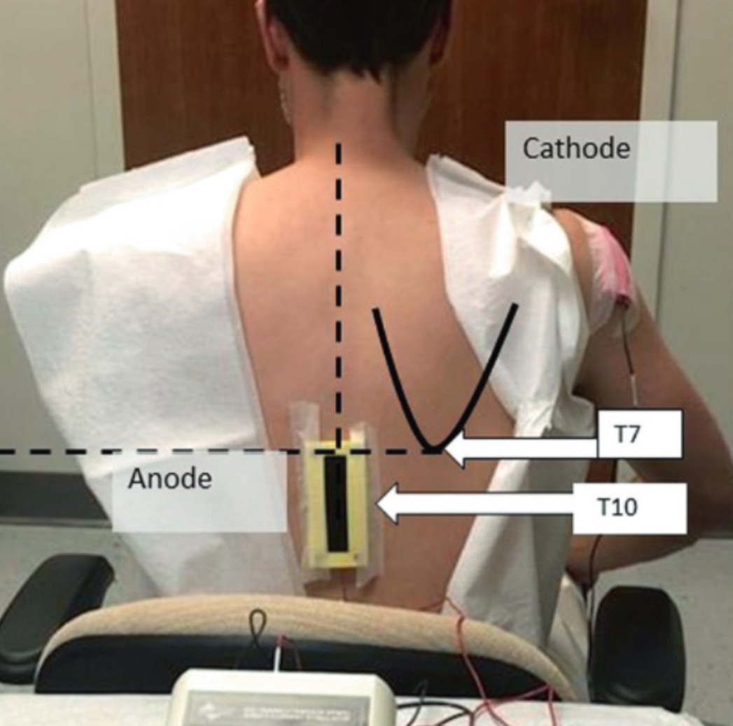 🔹#SpinalCordStimulation beyond #PSPS or #CRPS. The beauty of brain-body interaction mechanisms & the “neurobiological self“. The case of non-invasive #SCS & #depression as an example of dysregulation in this brain-body interaction! Decreasing the hyperactive signaling? De-

1/n