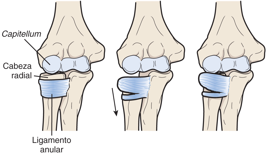 ¿Sabéis que es el #CodoDeNiñera o #PronaciónDolorosa? Es una subluxación de la #CabezaRadial. Se produce al aplicar una tracción longitudinal al brazo, que ocurre cuando un niño cogido de la mano se cae o cuando se le levanta por la mano. 📚Nelson. Tratado de pediatría © 2020