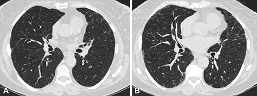 Progression of Lung Abnormalities in Smokers is Linked to Acute Respiratory Disease Learn more ➡️ bit.ly/3y5fA7q @radiology_rsna @binachoimd #RadNews #OncologicImaging #Cardiopulmonary