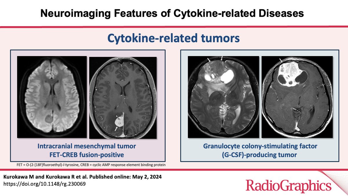 Neuroimaging Features of Cytokine-related Diseases | RadioGraphics pubs.rsna.org/doi/10.1148/rg…