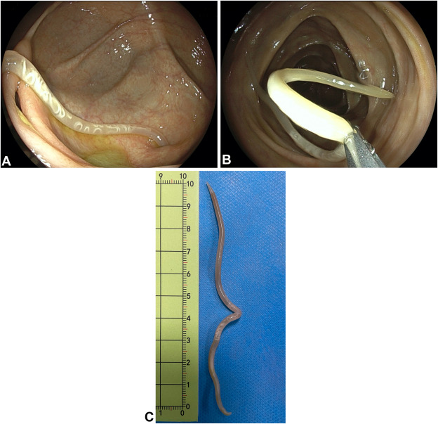 At the Focal Point, Zeng et al identify 'Ascaris lumbricoides in the appendicular orifice' giejournal.org/article/S0016-…
