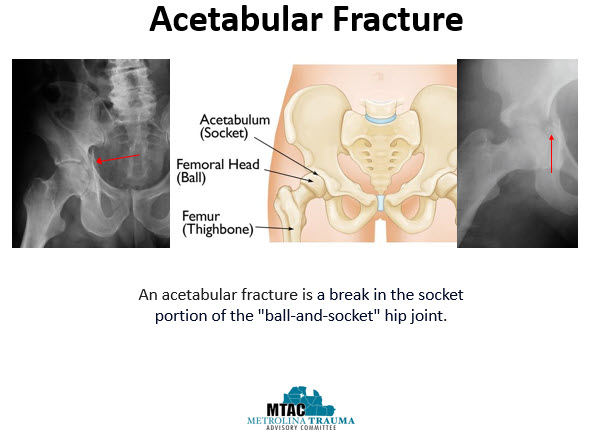 Acetabular fx involves the pelvis where the femur meets the acetabulum. The fx is caused by the head of the femur pushing against the acetabulum & may be a result of high (MVC) or low energy MOI (fall). #TraumaEducation #MetrolinaTrauma #SoMe4Trauma #FOAMed #EmergencyMedicine