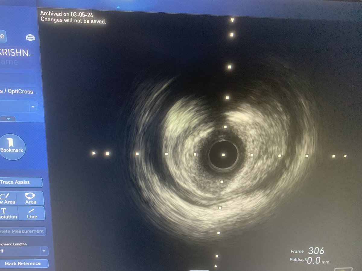 Mid night PPCI .. Ectatic RCA totally occluded .. huge thrombus load .. RCA reference size : 5mm. #CardioTwitter #ImageFirst