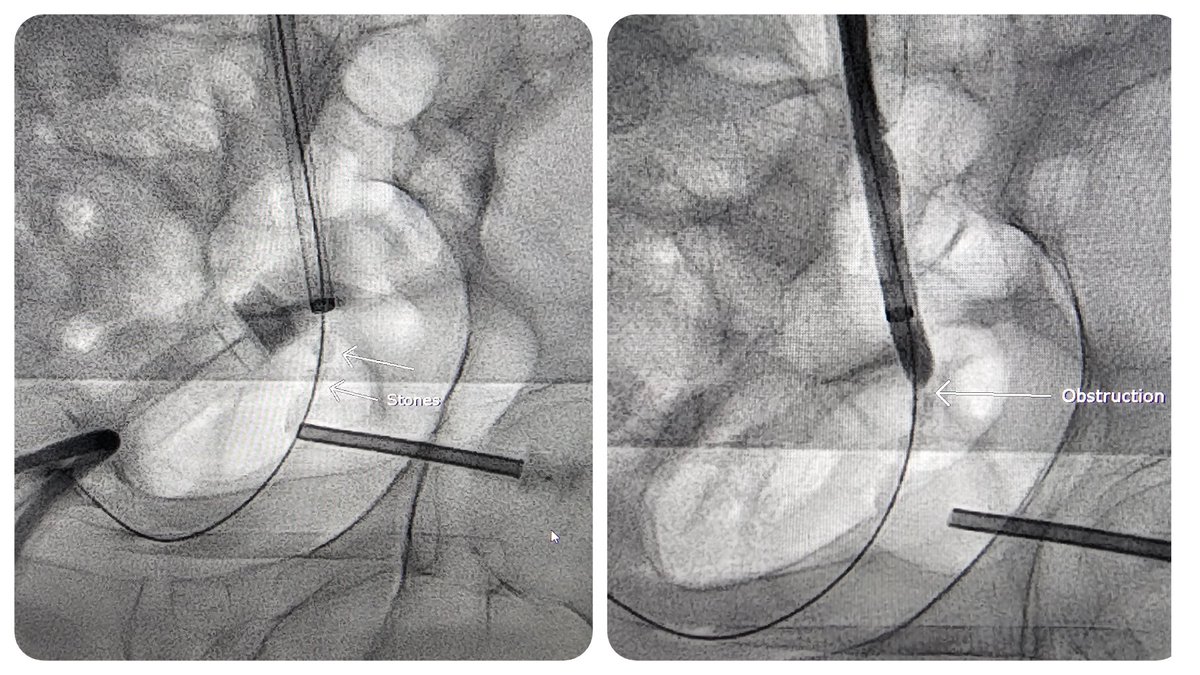 Percutaneous ureteral lithotripsy, a quick pictorial. @SIRspecialists @SIRRFS @SIR_ECS Pt with distal ureteral stones, not a surgical candidate, presents for percutaneous lithotripsy. Note the faint stones in the distal R ureter with obstruction.