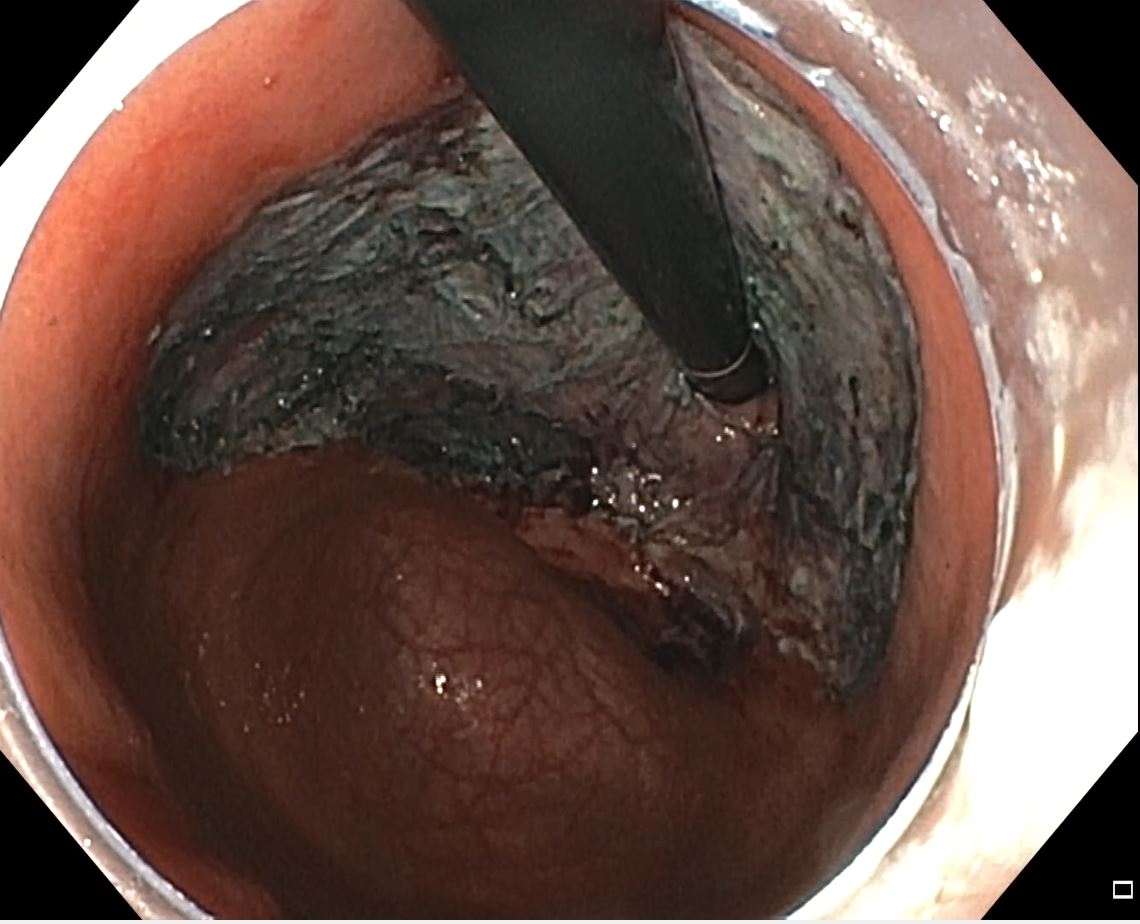 Circumferential early gastric cancer of the cardia. This has been the most difficult ESD for me (pT1a). Which one has been your most challenging case? #ESD #GItwitter #treatcancer @ASGEendoscopy @ESGE_news