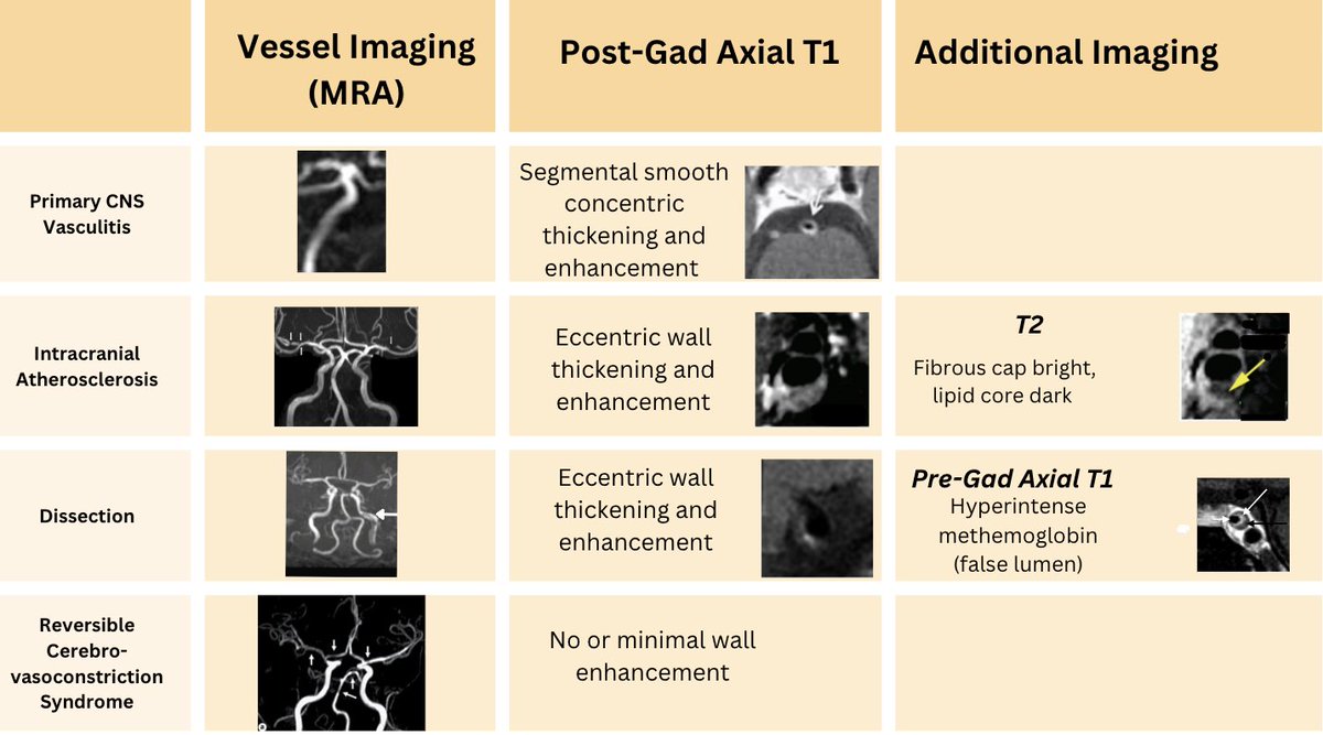 Having trouble distinguishing imaging findings of primary CNS vasculitis (PACNS),  intracranial atherosclerosis (ICAD), dissection, and reversible cerebrovasoconstriction syndrome (RCVS)? Same! So I made this--maybe it's helpful to you too!  #stroke #strokemed #meded…