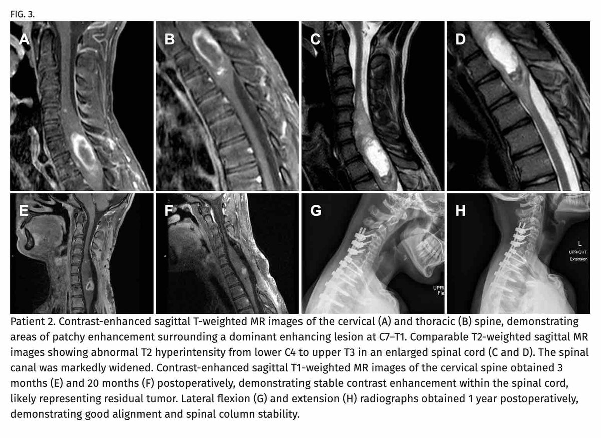 #OnlineFirst: Resection of intradural spinal lesions with concomitant instrumented fusion in children: a systematic review and representative cases. thejns.org/pediatrics/vie…