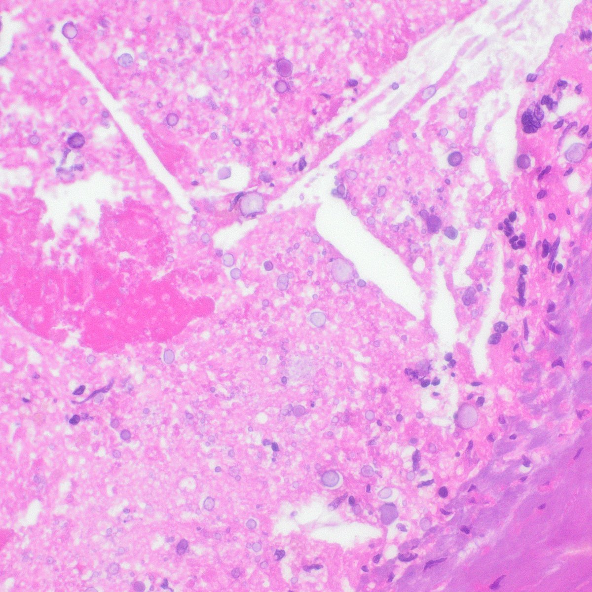 Bug thursday!

40 year old male with multiple cysts in the brain.

Can anyone tell me what type of bug this patient had and was treated for? 

Bonus points if anyone can name the showned structures.

#pathx #neuropath #pathology #pathologyresidents #Microbiology