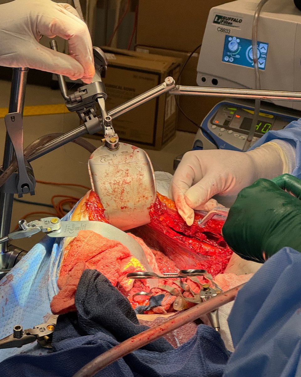 We were in the room where it happened! The first of it's kind - The Living Donor Liver Transplant Masterclass put on by the American Society of Transplant Surgeons! It was incredible watching the best of the best teach, learn, and use the Thompson Retractor for Exposure!