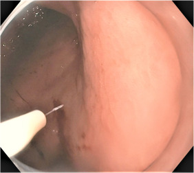 The article demonstrates a truly novel method of endoscopy directed high-pressure spray (power-wash) that safely detected gastric intestinal metaplasia and dysplasia on cytology. Check it out in the newest #TIGE issue: ow.ly/r3KB50RsYJW