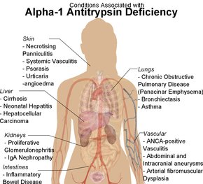 @drkeithsiau @BrownJHM @DrAkhilRaghavan @Janetbirdope @mendietaalex1 @modernHealthMe @NicoGagelmann @nihardesai7 @the_beardedsina @imedverse Yes 🙏 It's COPD (bilateral lower-lobe panlobular emphysema consistent with known history of  alpha1-antitrypsin deficiency) with necrotizing panniculitis and Chronic liver disease (liver cirrhosis)