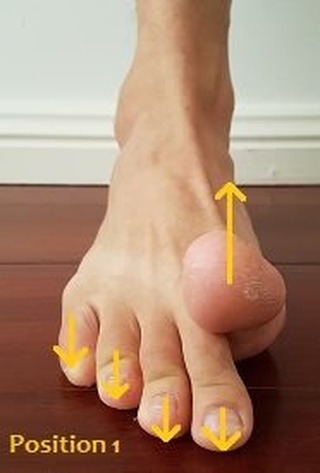 Learn about hammer toes from WebMD - when toe muscles are out of balance, they can cause painful problems. Hammertoe makes toes bend downward at the joint. Well-fitted shoes and surgery may offer relief. Podiatrists… halluxcare.com #bunion #bunionpain #tailorsbunion