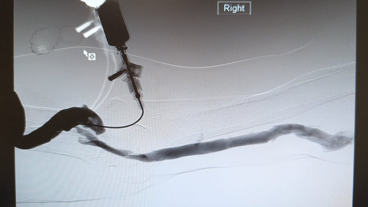 jflucas3's tweet photo. Radiocephalic fistula created in 2012. Has had 2 interventions. Now with severe stenosis at the elbow. Plan to repair aneurysms, tunnel fistula in new location and connect to basilic vein for outflow. https://t.co/ugi2CvCOUD