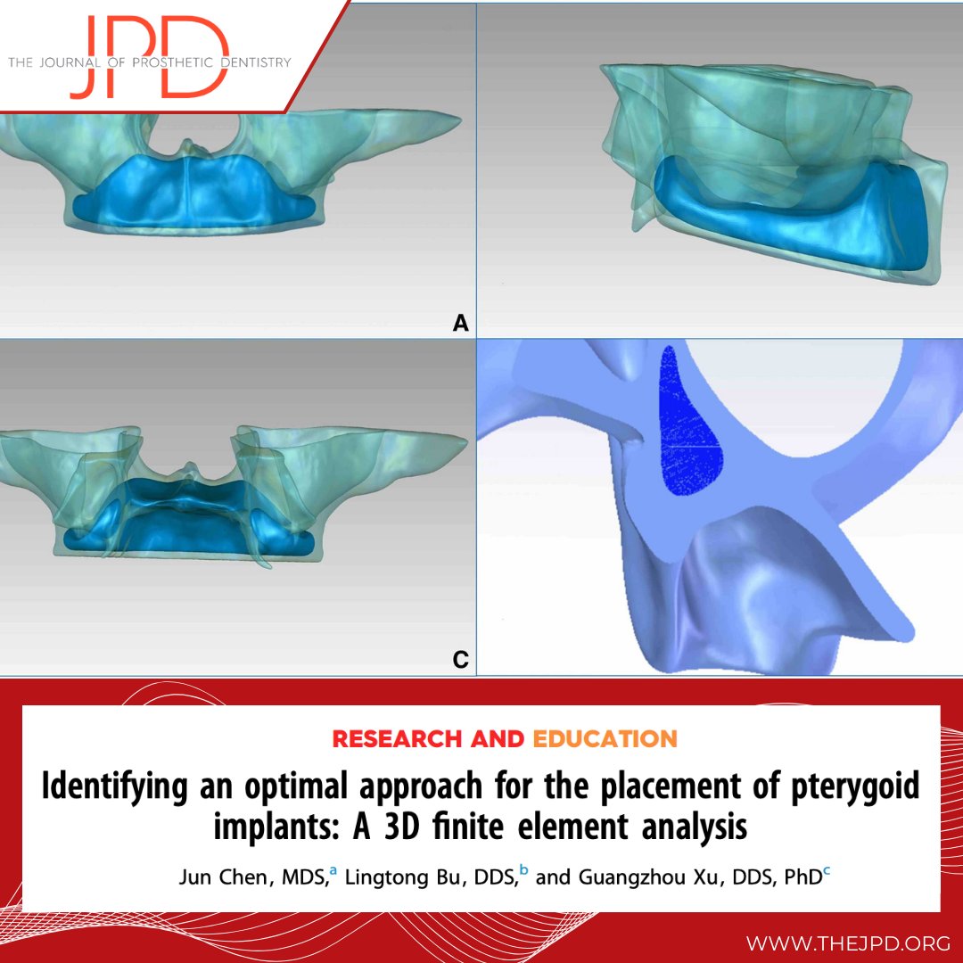This #finiteelementanalysis study evaluates the biomechanical stress distribution when pterygoid #implants are placed at different angulations as a part of a complete arch implant prosthesis in both dense and trabecular bone: thejpd.org/article/S0022-… 

#latestontheJPD