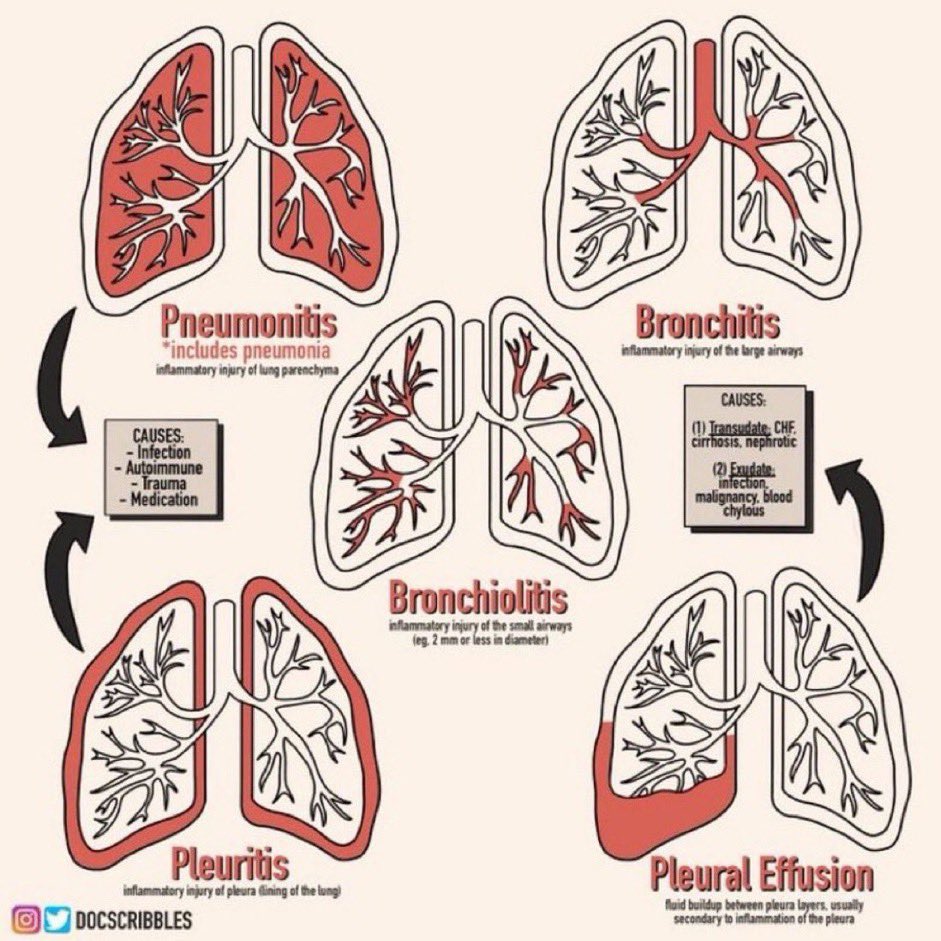 Helpful infographic on lung conditions 🫁 Cr. @DocScribbles #medtwitter @Sthanu5 @IhabFathiSulima @AvrahamCooperMD