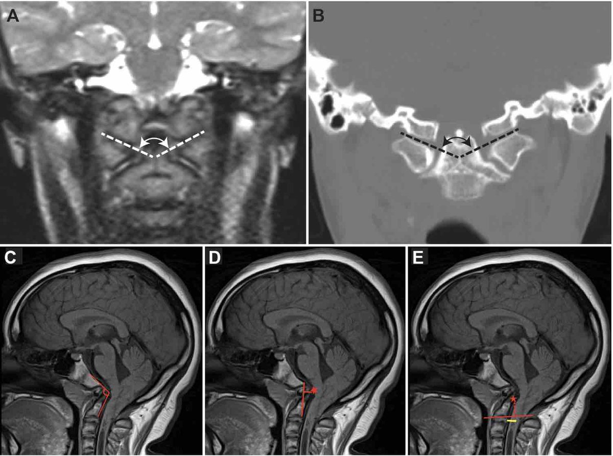 #OnlineFirst: The role of occipital condyle and atlas anomalies on occipital cervical fusion outcomes in Chiari malformation type I with syringomyelia: a study from the Park-Reeves Syringomyelia Research Consortium. thejns.org/pediatrics/vie…