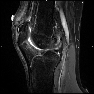 ❗️Case of the week: Quadriceps tendon harvesting for ACL graft. How often do you see it? Share your experience 👇 #MedTwitter #radres #OrthopedicSurgeon #orthopedics #kneesurgery #aclrepair #mri #radiology #foamed #foamrad #sportsmedicine