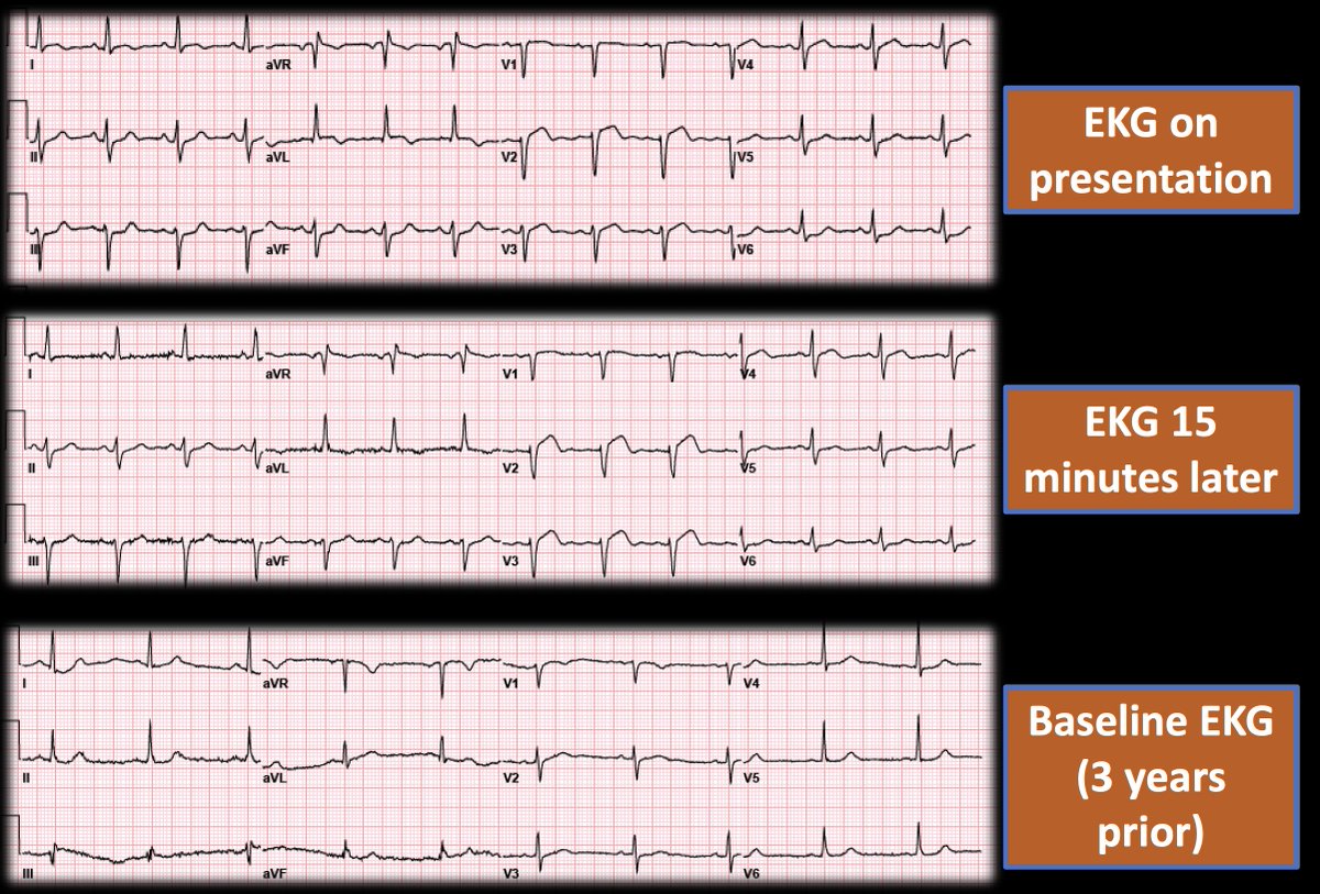 ✨Interesting #EKG Case: Patient presented to ER with chest pain. Cath lab was activated after #ECG on presentation, but somehow got another EKG 15 min later 👇 ❓What did the coronary angiogram show?🪡 #CardioTwitter #ACCFIT #Cardiology #MedTwitter @BCMHeart @smithECGBlog