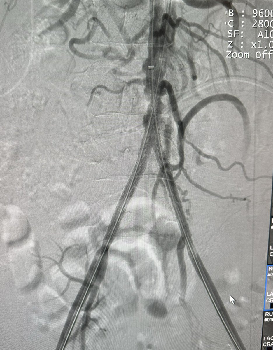 49 y old with left lower limb ischemia, CIA occlusion. 
Pre and post stenting. 
#IRAD
@Jeddah2HC