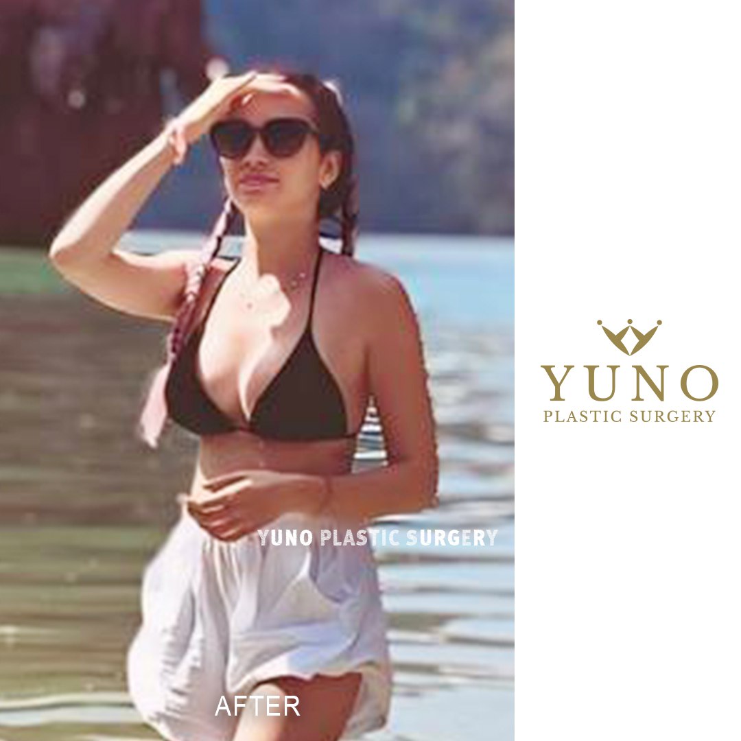 Secret beauty and more confident you 📷
📷Whatsapp: +82 10 2257 8670
📷Kakao: yuno_ps
📷Email: yuno.global@gmail.com
#yunoplasticsurgery #plasticsurgery #plasticsurgerykorea #breastaugmentation #breastenlargement #breastlift #korea #seoul #gangnam #surgeryinkorea #yuno