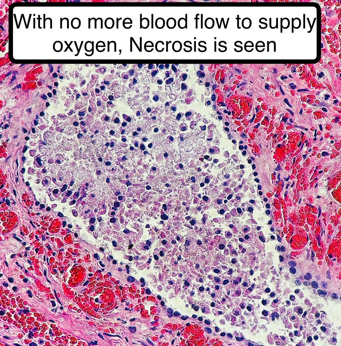 Urologic Emergency 🆘 

Testicular Torsion: Twisting of Spermatic Cord and Blood Supply

Demographics: Teens and Young Adults. 

Why it’s important: so clinicians can detorse as soon as possible since time is ischemia 👇 

#pathagonia #path4people #urology #medicalstudent #pathx