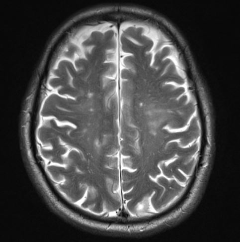 FRodriguezNP's tweet photo. 75-year-old man with progressive neurologic deficits and multiple small strokes. Make sure to look carefully at those small vessels!. #intravascular #lymphoma easy to miss. Patient diagnosed on brain biopsy. #neuropath #PCNSL #stroke https://t.co/ipOmpFKHz5