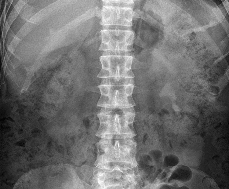 What is the cause of the abnormal calcification? A. Adrenal calcification B. Appendicolith C. Gallstones D. Pancreatic calcification E. Staghorn renal calculus