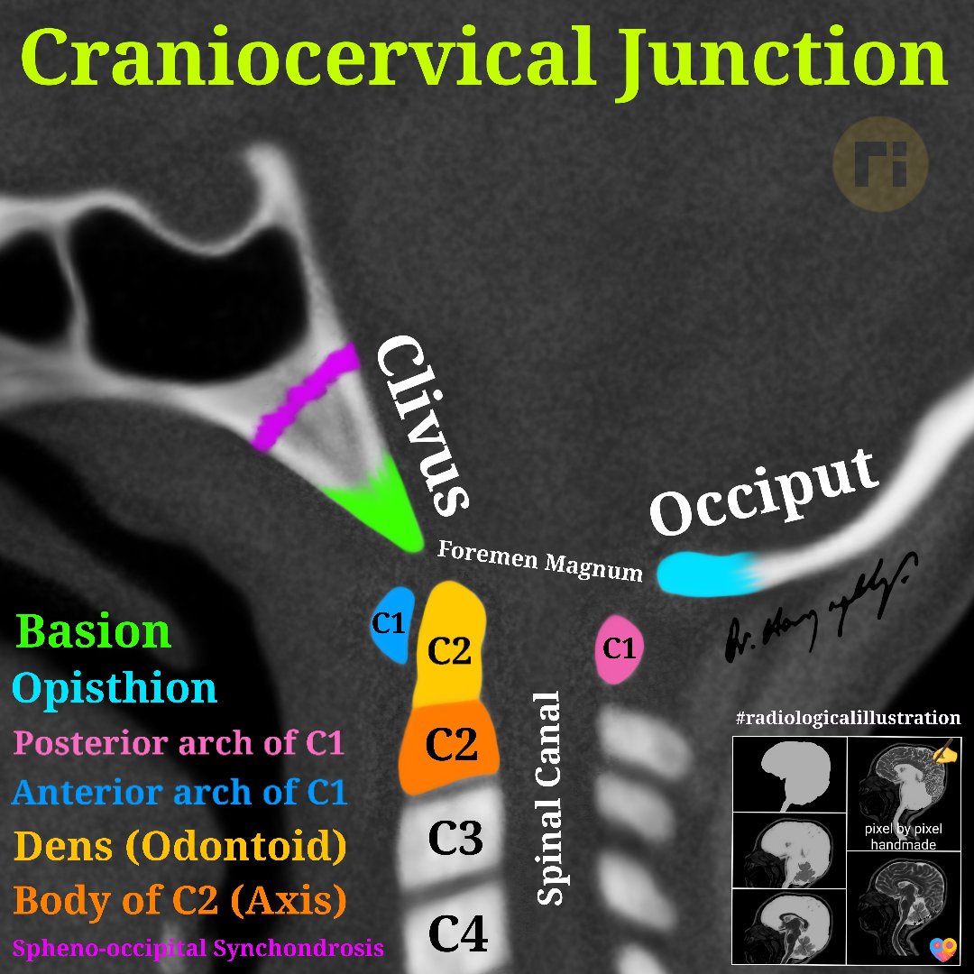 Craniocervical Junction / 2 📌 Is 'os odontoideum' a congenital variation of the C2 vertebra? 🤔 ...✍️ #radiologicalillustration ✍️ pixel by pixel handmade!