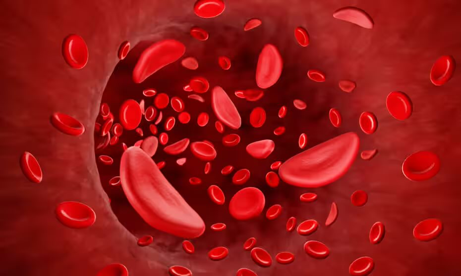 A new treatment for sickle cell disease has been recommended by the health watchdog in a move described as life-changing for people living with the condition in England. theguardian.com/society/articl… @NHSEngland @NICEComms @SickleCellUK @cahn_uk
