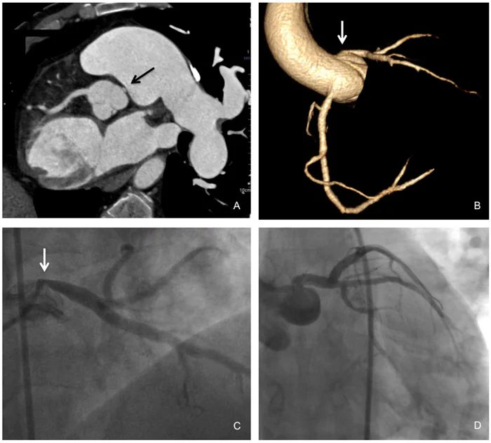 When breathlessness meets chest discomfort What do you see in this image submitted by a team from 🇲🇽 and selected for #EuroPCR? Take quiz here➡️pcronline.com/Cases-resource… #cardiotwitter