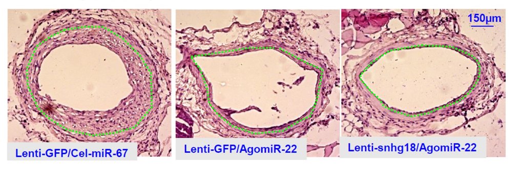 Small nucleolar RNA host gene 18 (SNHG18) ⬆️miR-22-3p to promote vascular smooth muscle contractile phenotype & ⬇️neointimal #hyperplasia Is miR-22-3p a target for #VascularDisease? bit.ly/3whJLaH @CVR_TomaszGuzik @DrMikeDrozd @glenpyle #miRNA #CardiovascularResearch