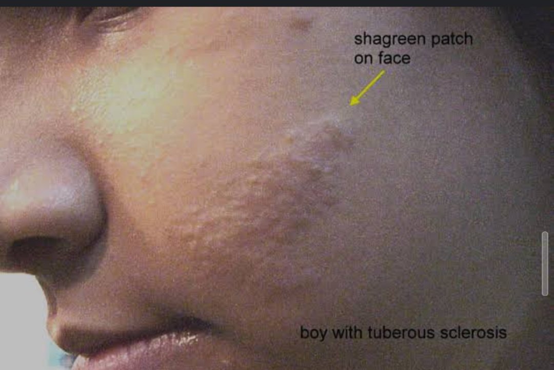 Patient present with shagreen patches,ash leaf macules 
Comment your diagnosis 
#NEETUG #NEET #USMLE #MedX #medicine #MEDebate #b0105