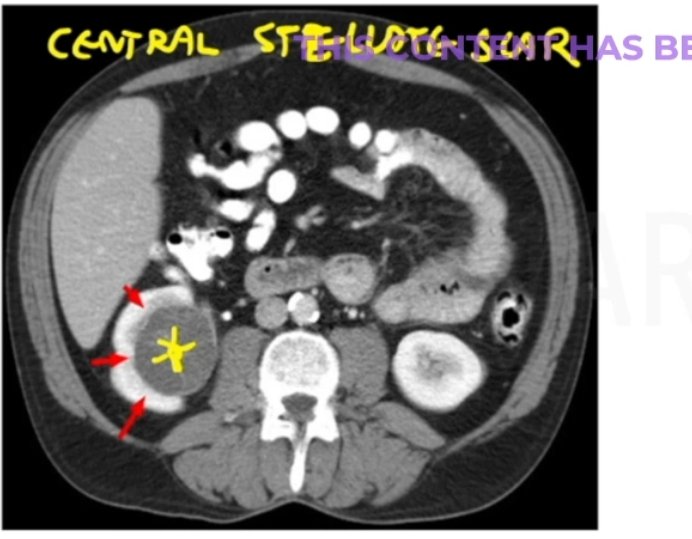 central stellate scaring on CECT
Comment DDx? 
spot the diagnosis?

#NEETUG #NEET #USMLE #MedX #medicine #MEDebate #b0105