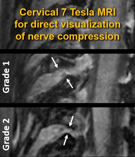 Out now in print & #OpenAccess: 7T MRI of the cervical neuroforamen 👉doi.org/10.1097/rli.00…

We demonstrated that #7T DESS imaging can directly assess cervical nerve root compression, pushing the boundaries of spine imaging

@FeuerriegelG @derbalgrist @SiemensHealthPR #MSKrad