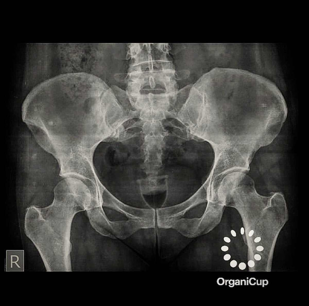 Regl kabı röntgene yansırsa? 😍

allmatters.com.tr 

#regl #reglkabı #adetkabı #menstrualcup #organicup #allmatters #ped #tampon #adetdönemi #reglsancısı #kramp