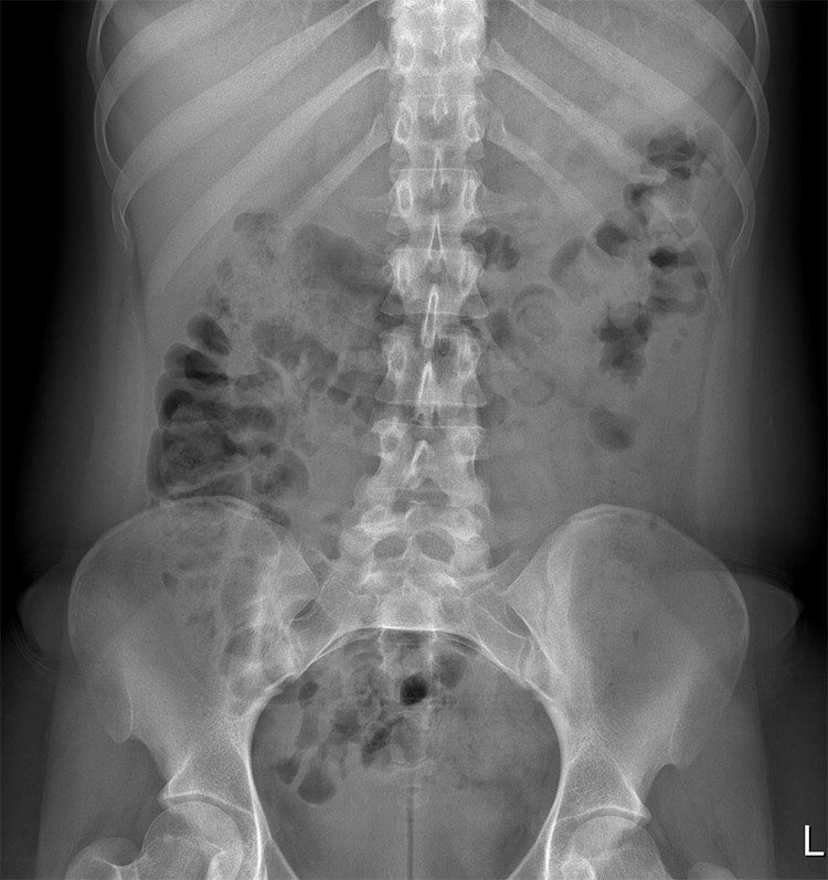 Patient with acute abdominal pain. What does the X-ray show? A. Caecal volvulus B. Normal appearances C. Pneumoperitoneum D. Small bowel obstruction E. Toxic megacolon