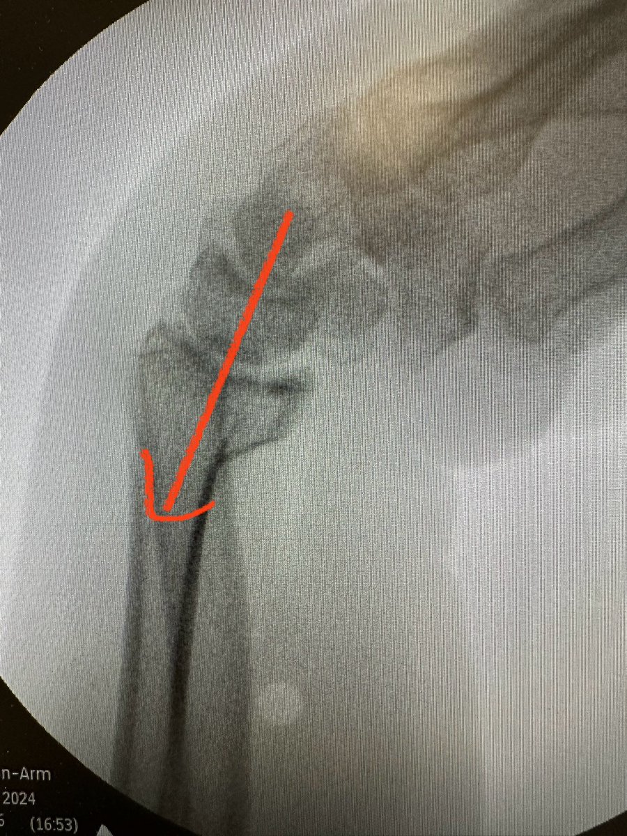 Volar Barton fractures will displace when splinted in extension because the carpus will load on the unstable volar rim fragment. 
Flexion directs the load to the intact dorsal side (temporarily, because your surgically fix this anyway!)

#OrthoTwitter